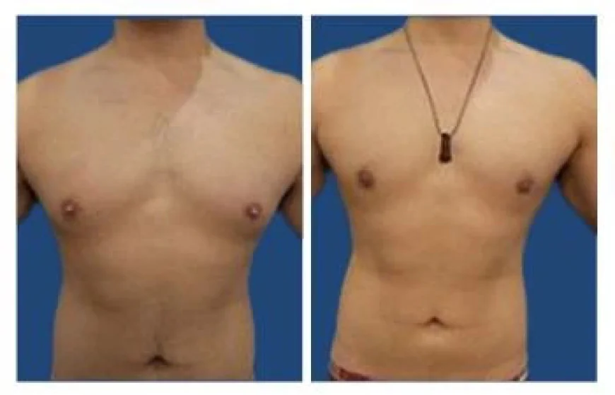 Best Solutions for Gynecomastia in Islamabad
