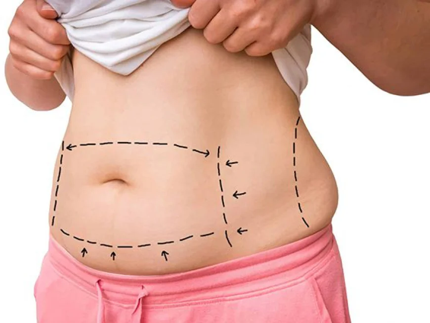 BodyTite Liposuction for Smooth Skin and Sculpted Curves