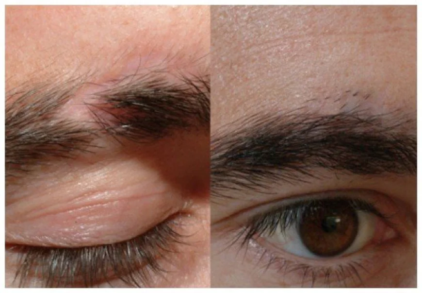 Redefine Your Look: The Complete Guide to Eyebrow Hair Transplant in Islamabad