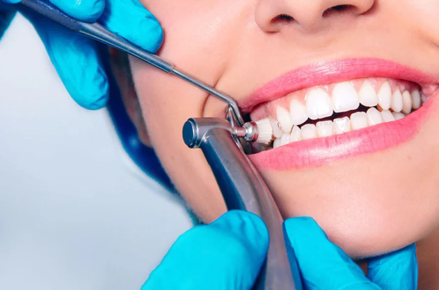 Is Teeth Polishing an Essential Part of Dental Hygiene?