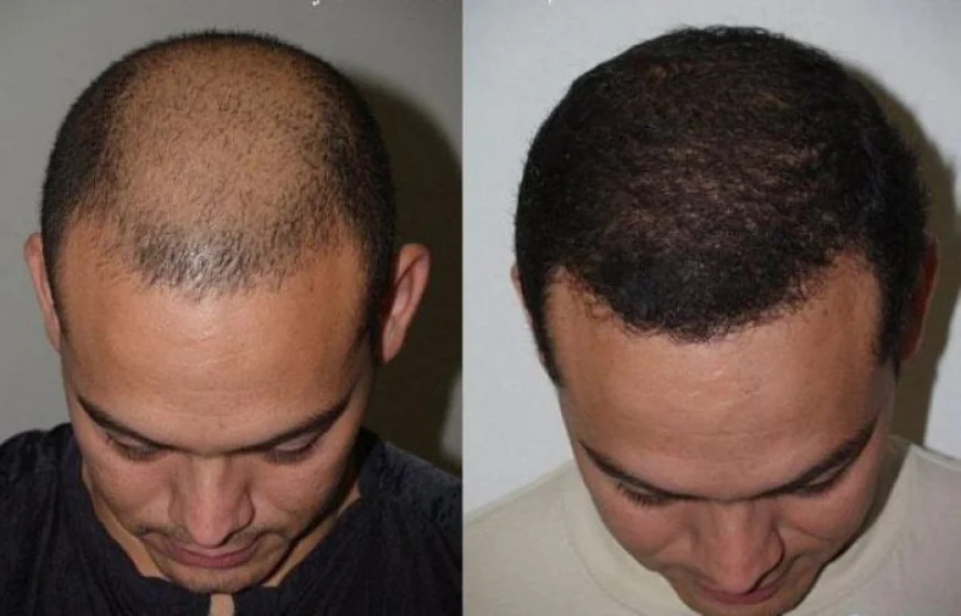 The Ultimate Guide to FUE Hair Transplant in Islamabad: Restore Your Confidence and Hair