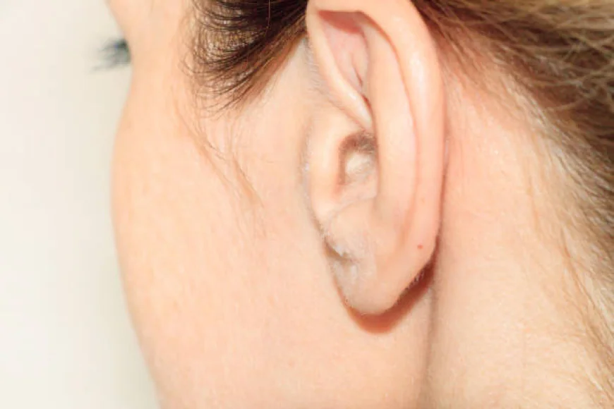 Bat Ear Correction with Otoplasty in Dubai: Complete Guide