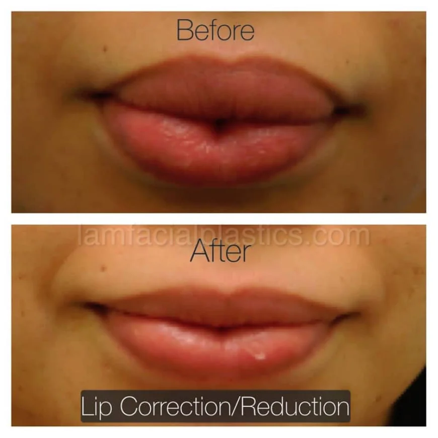 Lip Reduction in Islamabad: Achieving Facial Harmony and Lasting Confidence