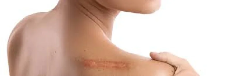 How Are Hypertrophic Scars Different from Keloid Scars?