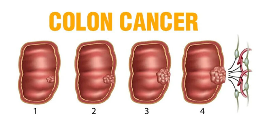 Age and Colon Cancer Symptoms: What Different Generations Need to Know