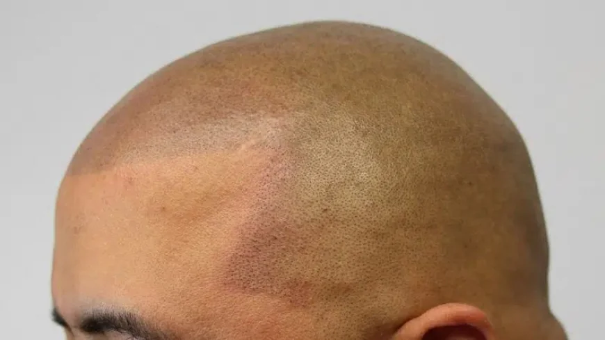 Common Misconceptions About Scalp Micropigmentation