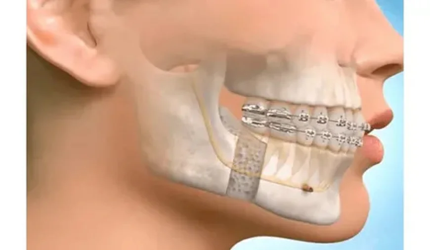 Jaw Surgery in Islamabad – Procedures, Benefits, and Results