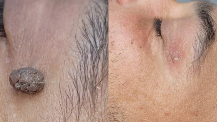 Understanding Warts: Causes, Symptoms, and When Removal Is Needed