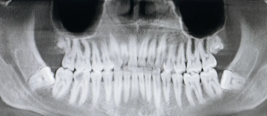Panoramic Dental X-Ray Cost in Dubai