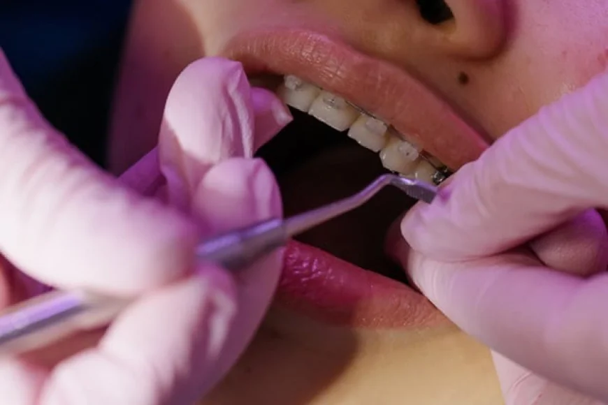How Long Does Invisalign Treatment Take in Aventura?