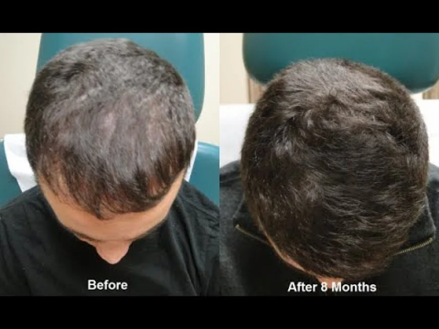 The Ultimate Guide to the Best Hair Growth Treatments in Islamabad: Reclaim Your Confidence