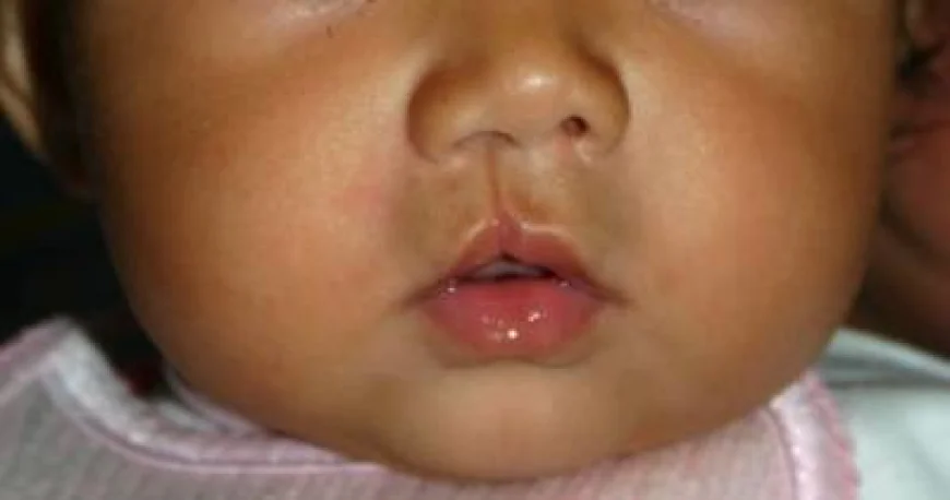 Cleft Lip Surgery in Islamabad: Step-by-Step Procedure Explained