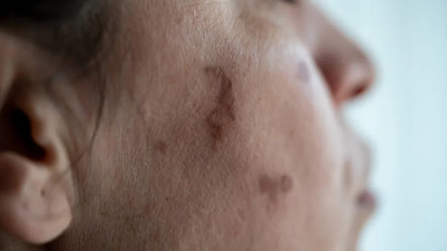 Birthmark Removal in Dubai: Laser Therapy for Face and Body Explained