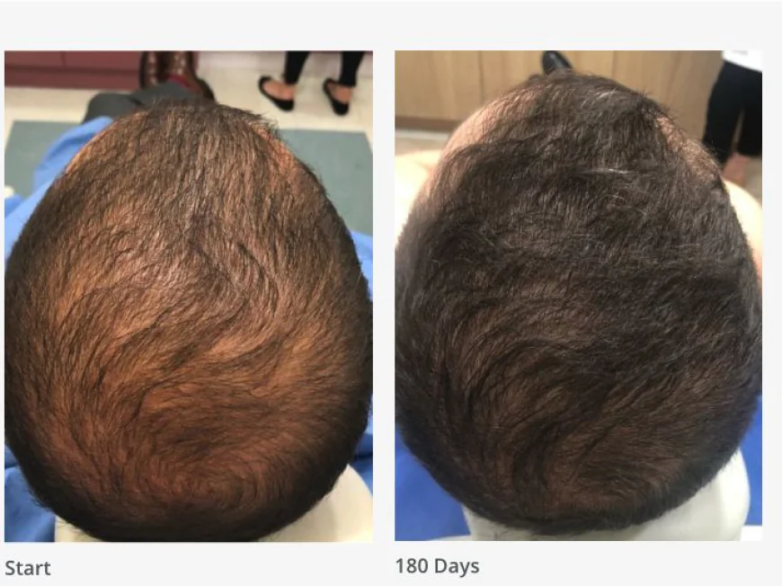 Hair Transplant in Dubai as a Personal Hair Loss Decision