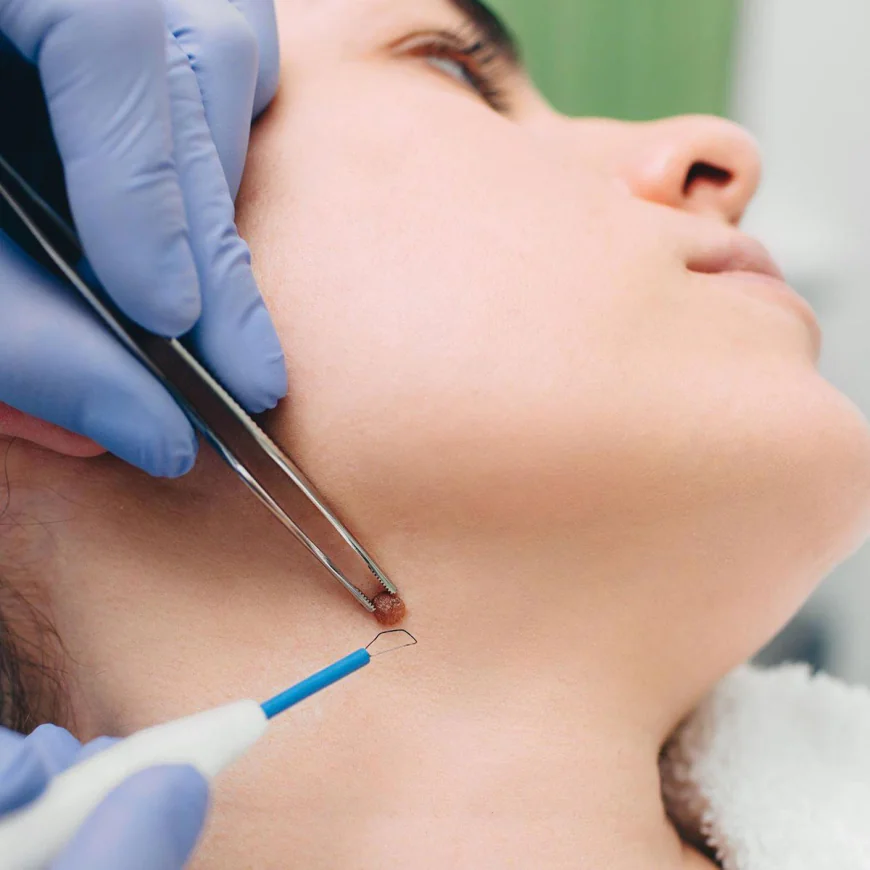 Mole removal in Dubai: A Path to Renewed Skin Confidence