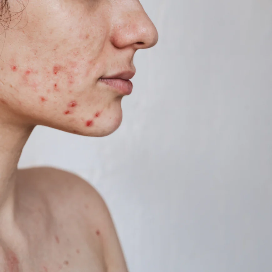 Microneedling for Acne Scars in Dubai: Restore Your Skin Naturally