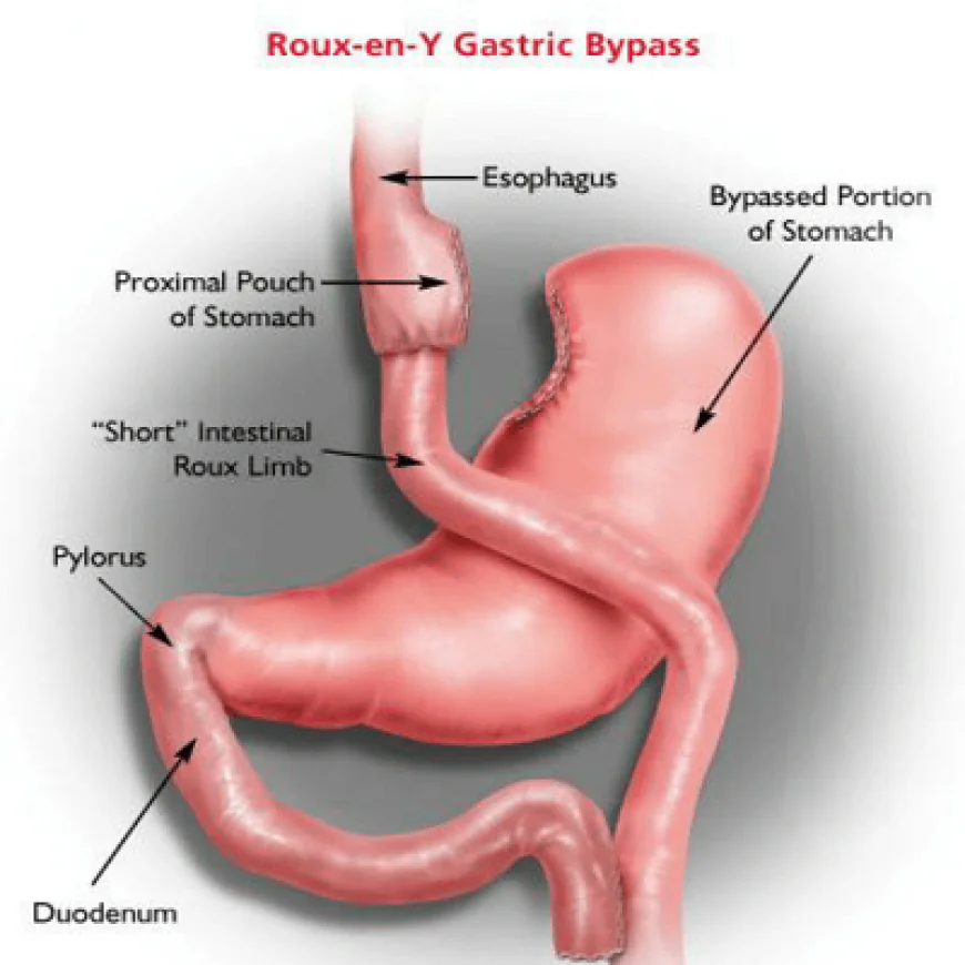 Gastric Bypass Recovery Time: What to Expect From Surgery to Full Healing