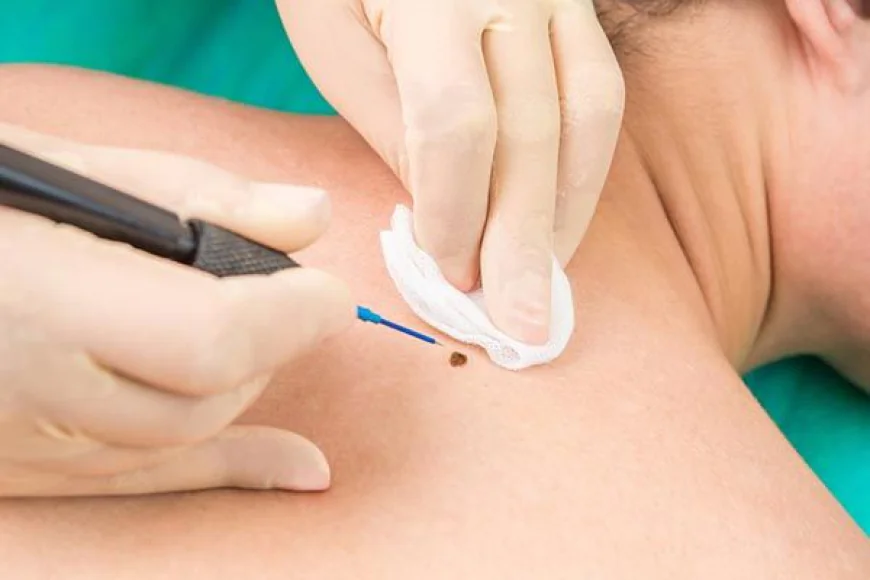 Blog 5 Mole removal in Dubai: Understanding the screening process