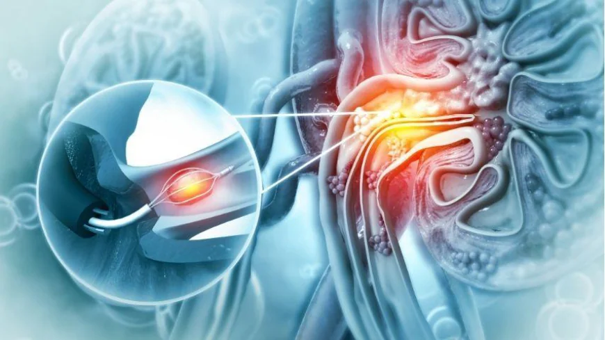 Is laser treatment better than shock wave therapy?