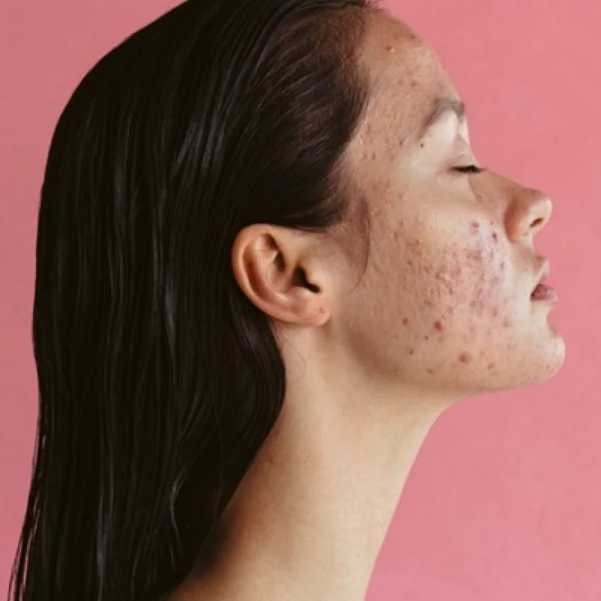 Quick Acne Treatment for Stress-Induced Breakouts