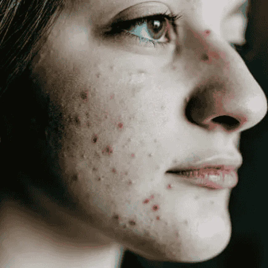 Acne Treatment Ingredients That Beginners Should Know