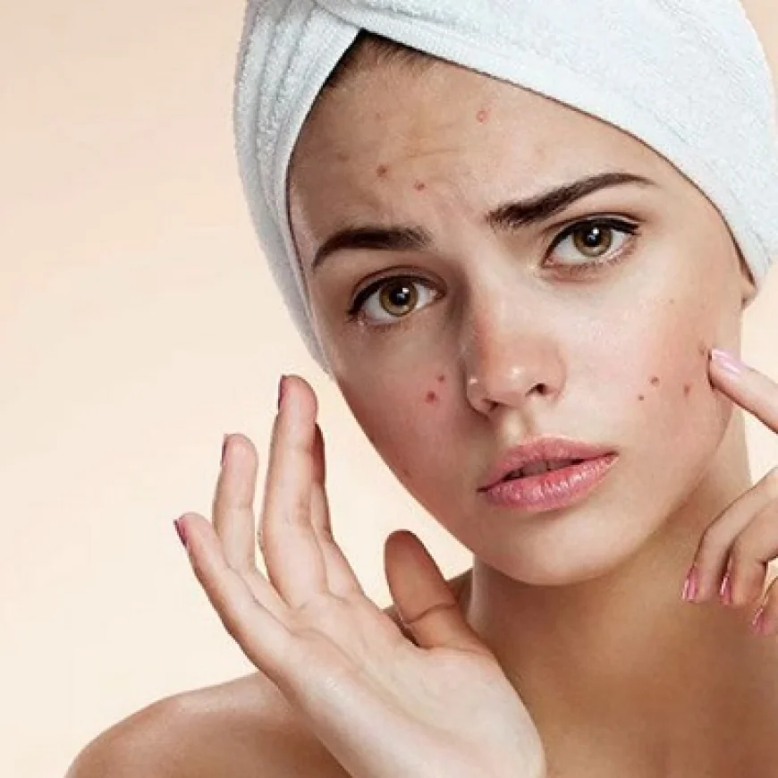 How to Treat Small Acne Bumps With Simple Products