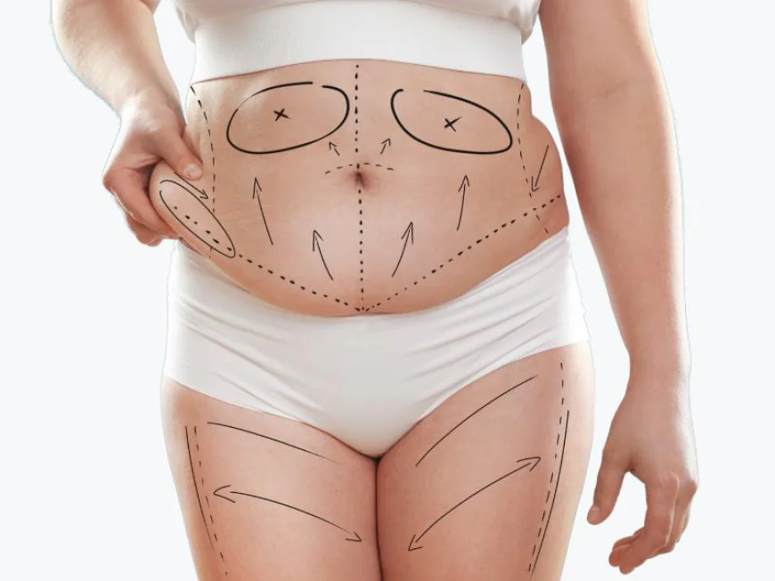 Tummy Tuck Surgery: Step-by-Step Procedure Explained