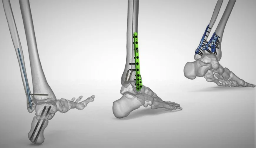  Orthopedic Implants: Restoring Mobility and Quality of Life