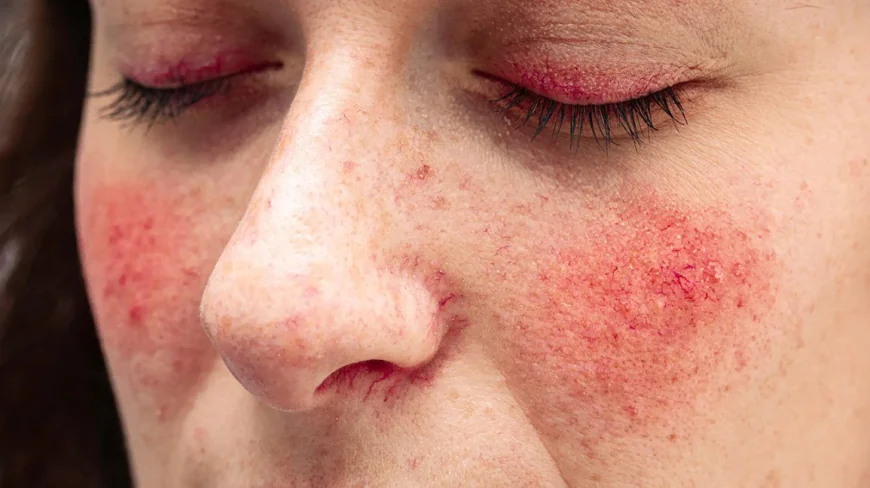 Best Rosacea Treatment in Dubai for Long-Lasting Relief