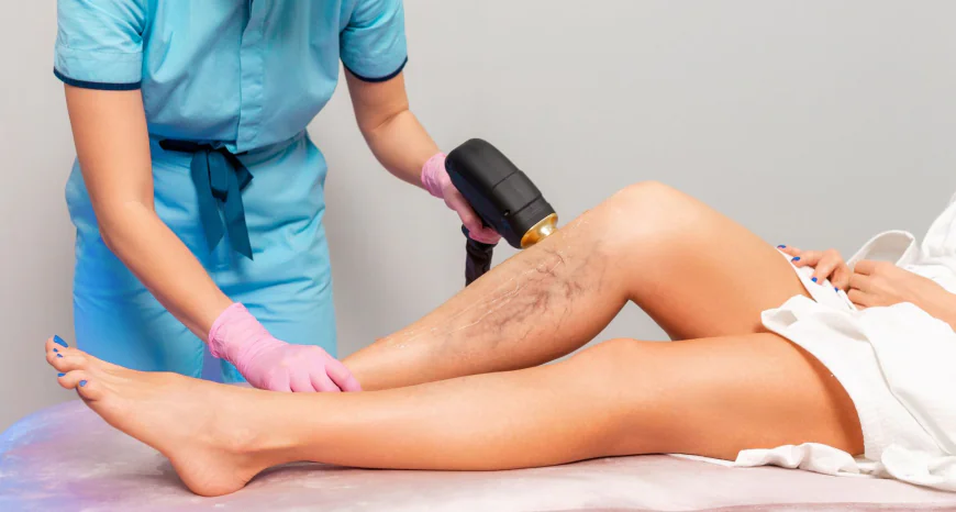 How Laser for Spider Veins in Dubai Works: Procedure, Pain & Recovery