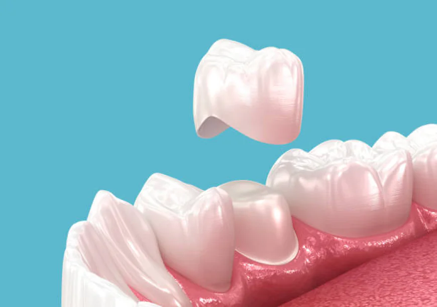 Why Are Dental Crowns in San Jose an Important Part of Complete Dental Care?