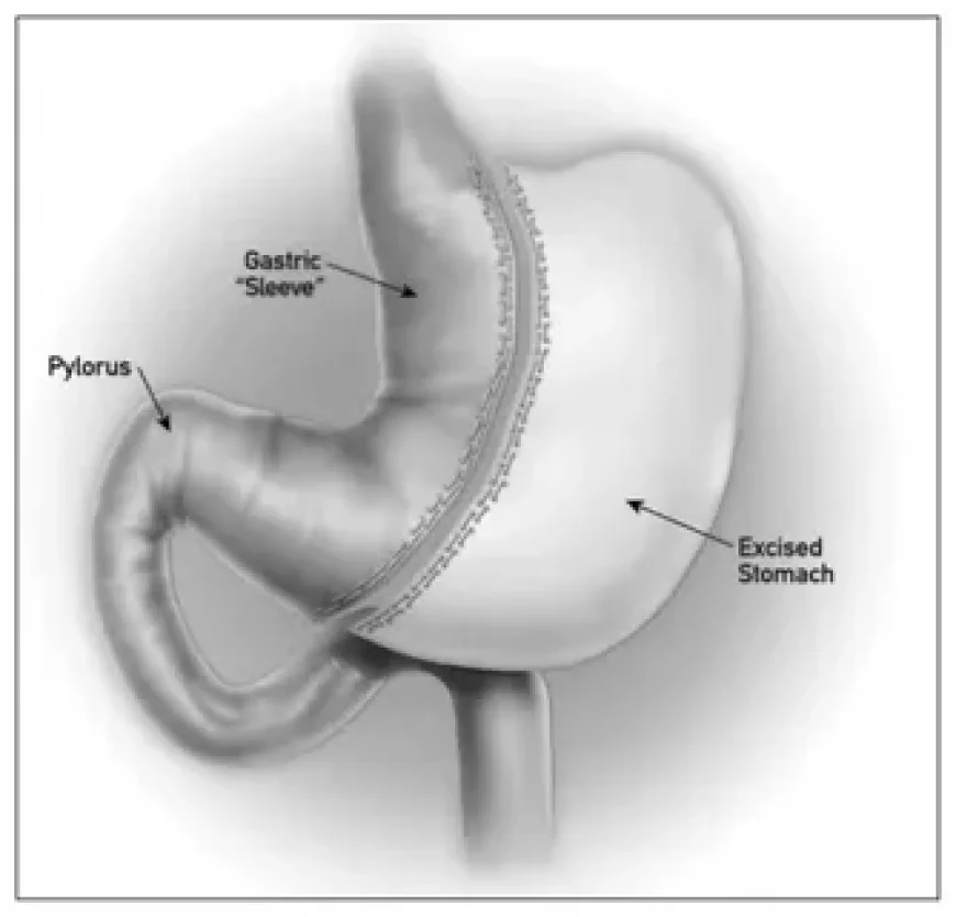 Common Myths About Sleeve Gastrectomy—Debunked