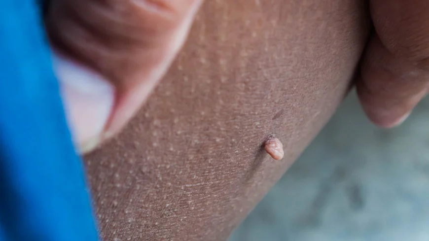 Advanced Laser Skin Tag Removal in Dubai Explained