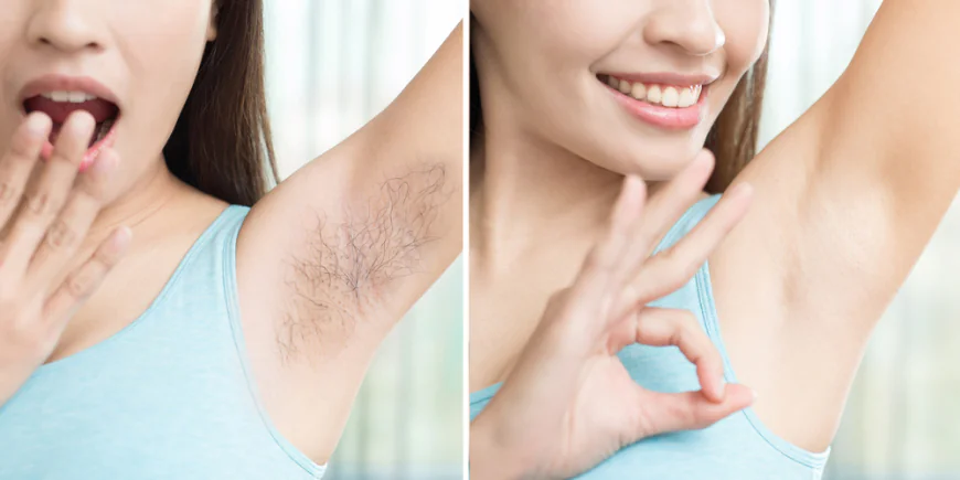 Say Goodbye to Razors: The Ultimate Guide to Armpit Hair Removal in Islamabad
