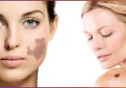 Latest Birthmark Removal Technologies in Dubai Clinics