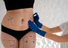 Liposuction: Treatment Areas, Recovery, and Results