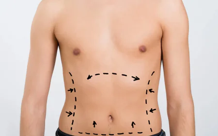 Tummy Tuck in Islamabad – Redefine Your Waistline