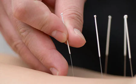 Acupuncture Treatment in Dubai: What to Expect