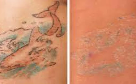 Affordable Laser Tattoo Removal Dubai Clinics Revealed