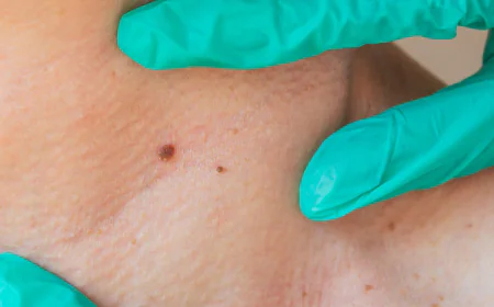 Where Do Skin Tags Most Frequently Develop on the Body?