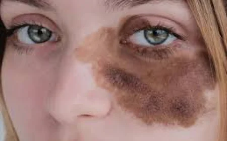 Laser Birthmark Removal Specialists in Dubai