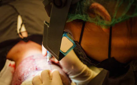 1 Dirham Hair Transplant Heals Bald Spots Effortlessly