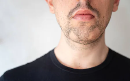 Alopecia Areata Treatment in Dubai for Rapid Regrowth