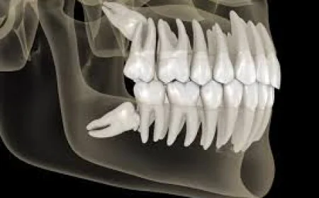 Effective Wisdom Teeth Pain Relief Methods You Can Try