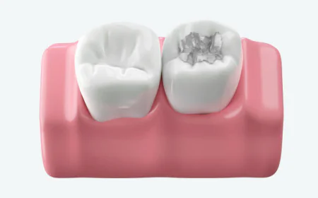 A Smart Solution for Cavity-Free Teeth Dental Fillings in Islamabad: