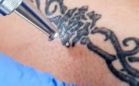 Safe Tattoo Removal Options in Dubai