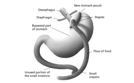 Gastric Bypass Recovery Timeline: What to Expect Week by Week