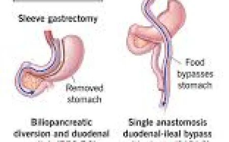Bariatric Surgery 2026: Your Complete Guide to Safe and Effective Weight Loss