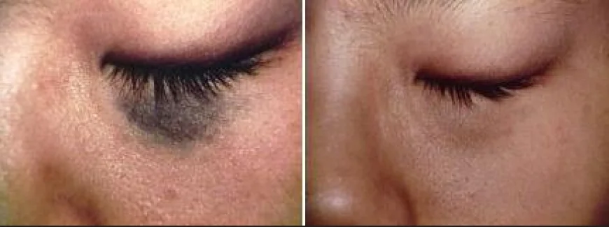 A Friendly Guide to Choosing the Best Birthmark Removal Clinics in Dubai