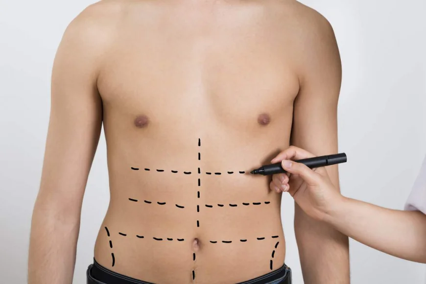 Liposuction Cost in Dubai Explained to Achieve Sleek and Shaped Curves